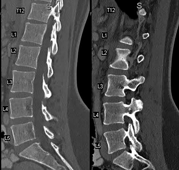 Lumbar spinal stenosis (grading), Radiology Reference Article
