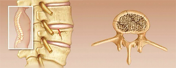 Vertebral compression fracture (VCF): Vertebroplasty and Kyphoplasty