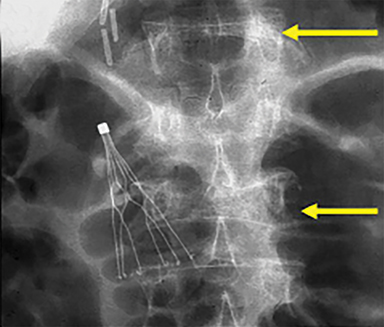 Percutaneous Vertebroplasty for Osteoporotic Compression