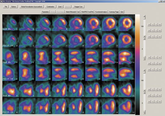 Assessment of Myocardial Viability Using Nuclear Medicine Imaging in  Dextrocardia