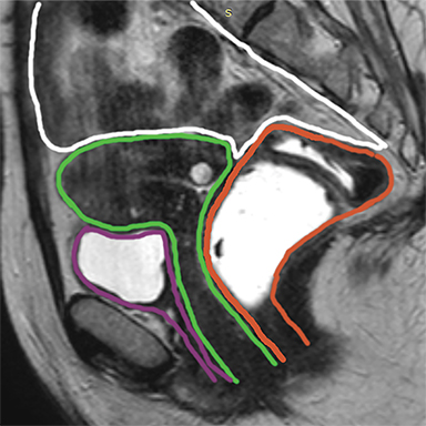 Levels of pelvic floor support: what do they look like on magnetic  resonance imaging?