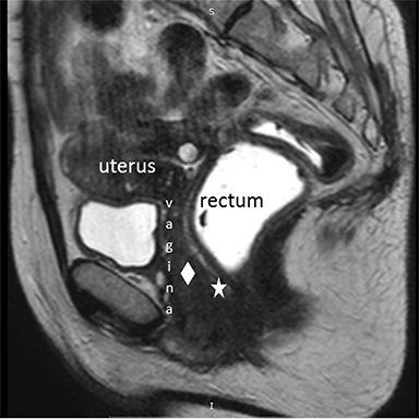 Bladder prolapse into vagina, Radiology Case