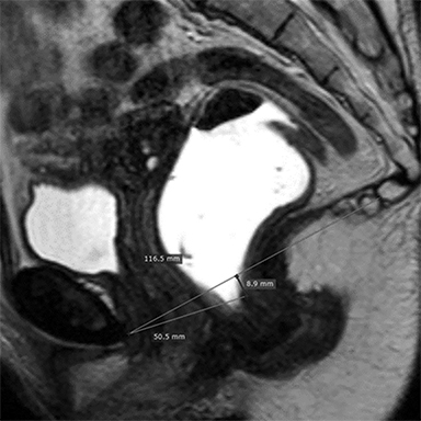 Bladder prolapse into vagina, Radiology Case