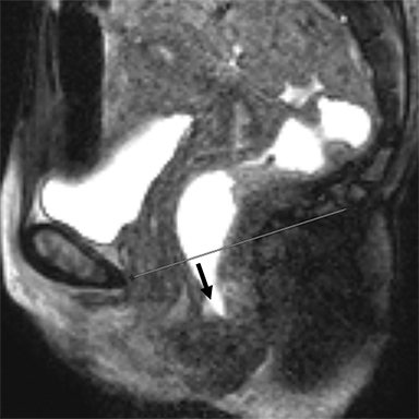 Bladder prolapse into vagina, Radiology Case