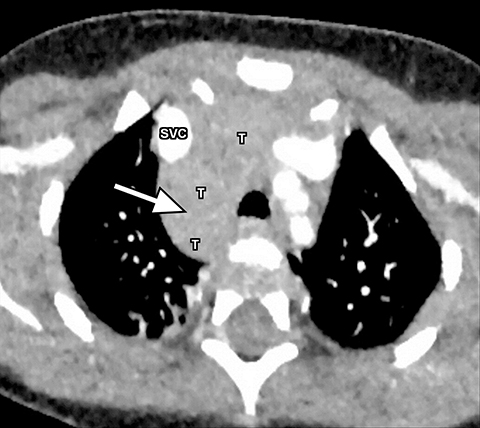 Imaging Evaluation Of Pediatric Mediastinal Masses: Pearls And Pitfalls 