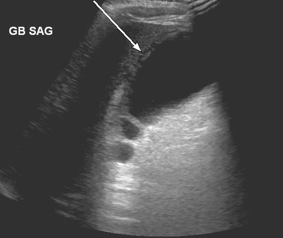 perforated gallbladder ultrasound