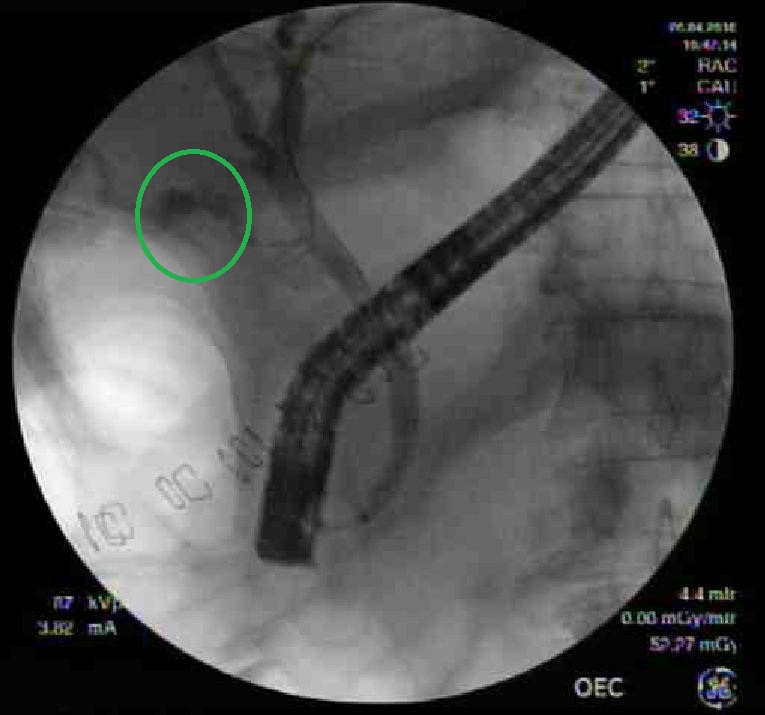 cholecystitis x ray