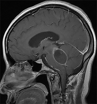 hydrocephalus mri