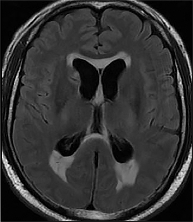 hydrocephalus mri