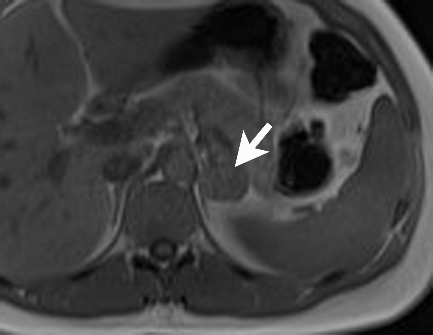 Adrenal imaging: A three-category approach to managing incidentalomas ...