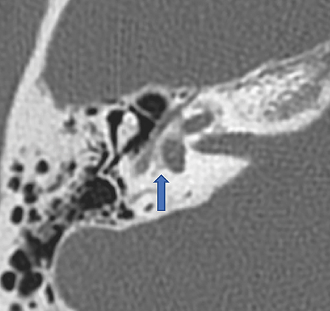 Stapes, Radiology Reference Article