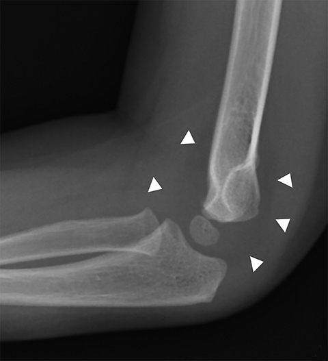 Normal foot x-ray - 2-year-old, Radiology Case