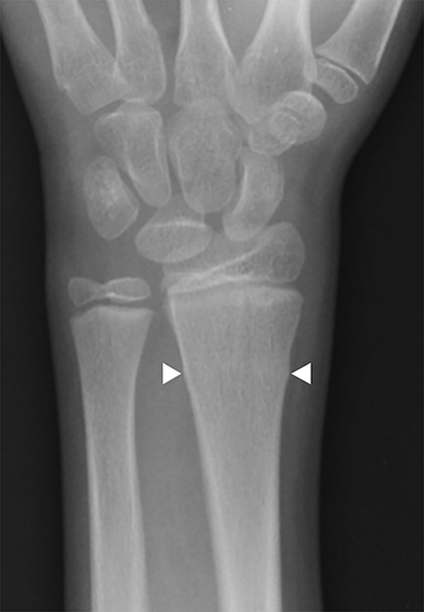 Normal feet x-ray - 7-year-old, Radiology Case