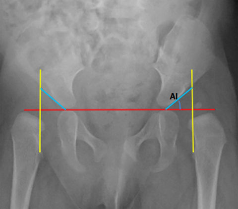 Metaphysis, Radiology Reference Article