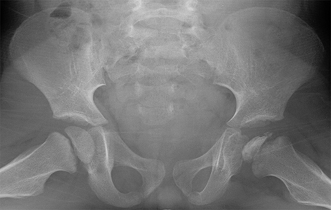 Metaphysis, Radiology Reference Article