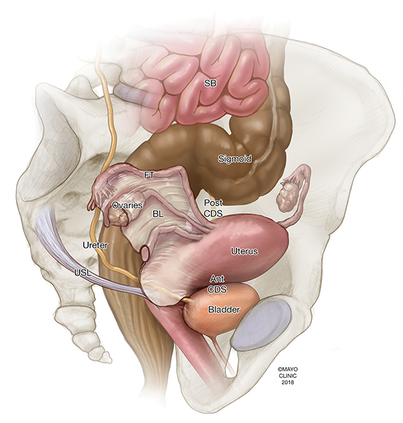 Hemorrhagic Ascites, Belly-Blood: The cause may be endometriosis