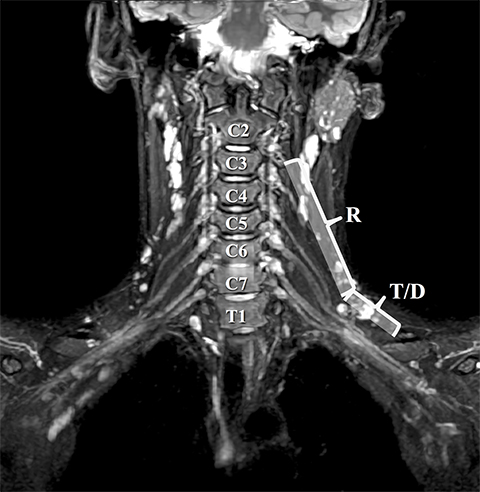 brachial plexus anatomy mri