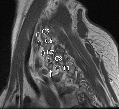 brachial plexus anatomy mri