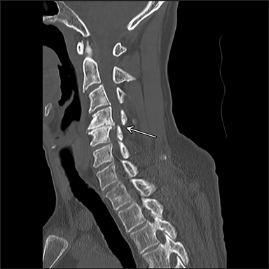 Traumatic Neuroma of an Intradural Cervical Nerve Root, Without Trauma ...