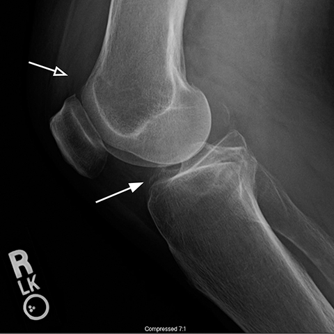 Can We Diagnose ACL Injuries Based on X-ray Findings Alone?