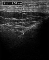 Can We Diagnose ACL Injuries Based on X-ray Findings Alone?