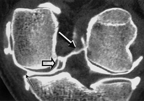 Anterior Cruciate Ligament and Meniscal Tears: A Multi-modality Review •  APPLIED RADIOLOGY