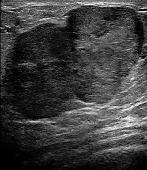 Breast disease in the pregnant and lactating patient: radiological