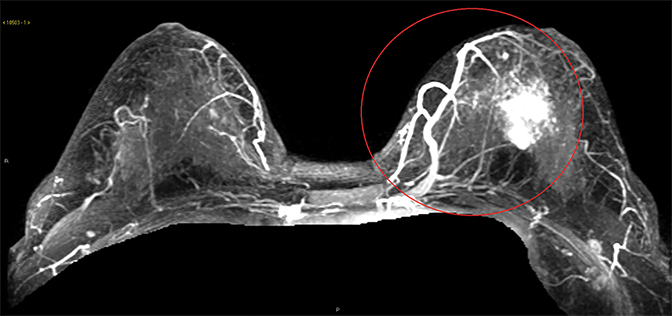 Breast disease in the pregnant and lactating patient: radiological