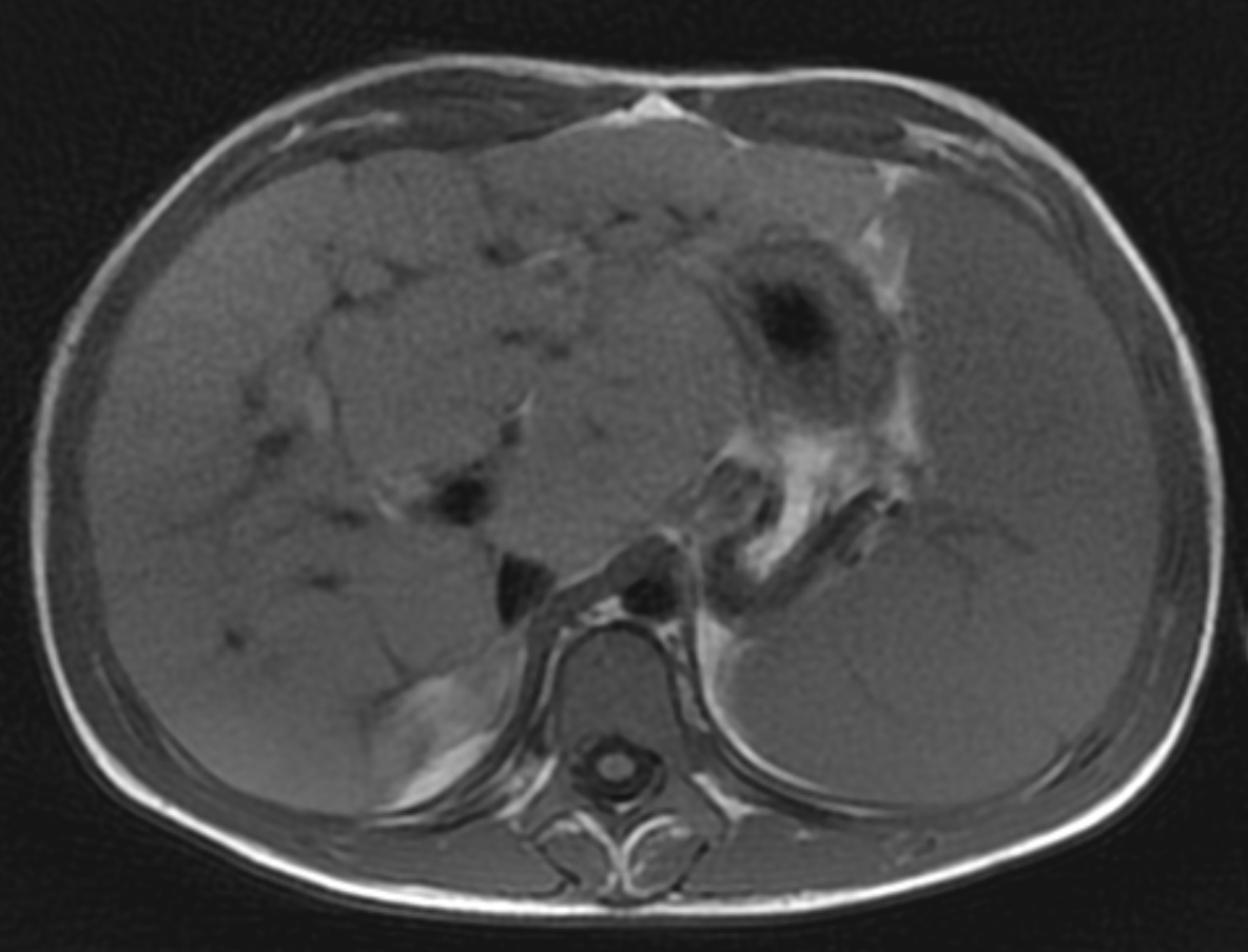 Cystic Fibrosis Liver Disease | Applied Radiology