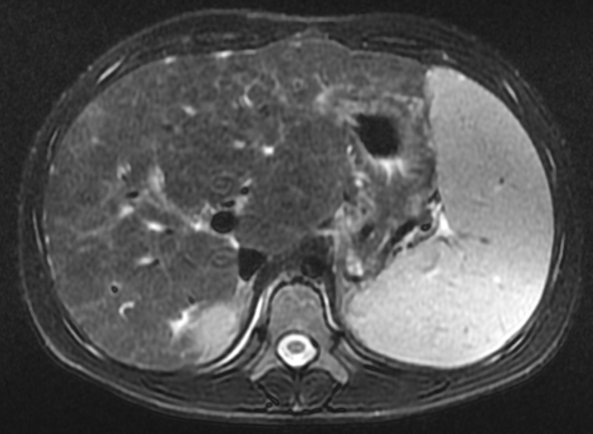 Cystic Fibrosis Liver Disease | Applied Radiology