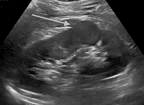 kidney ultrasound images abnormal