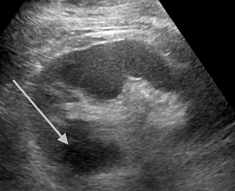 kidney cyst ultrasound and biopsy procedure