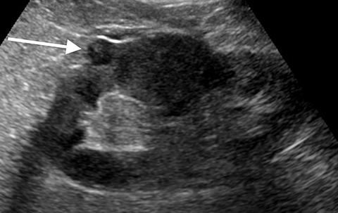 kidney ultrasound tumor