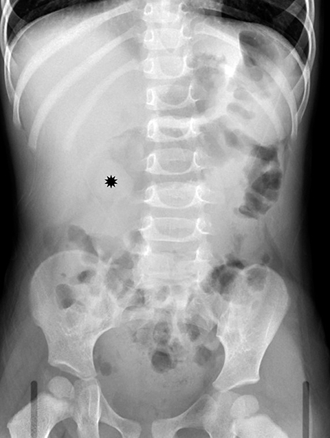 intussusception x ray