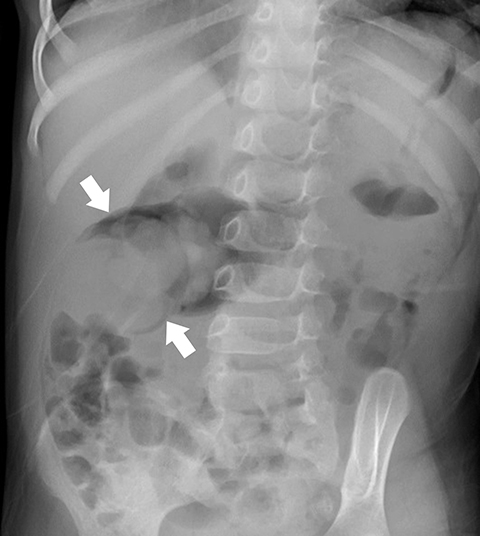 intussusception x ray