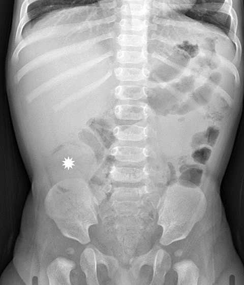 intussusception crescent sign