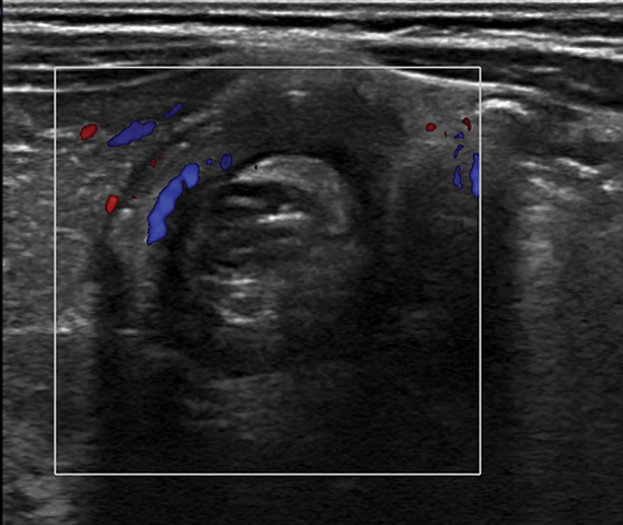Suspect flank pain? Consider ultrasound for first-line imaging • APPLIED  RADIOLOGY