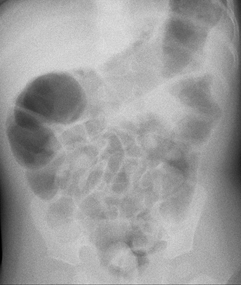 intussusception x ray