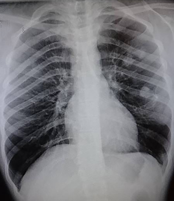 Rib Osteochondromas Mimicking Lung Nodules • APPLIED RADIOLOGY