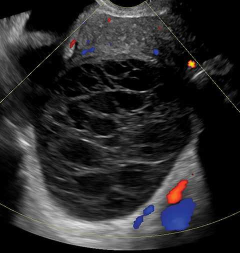 healthy ovarian ultrasound