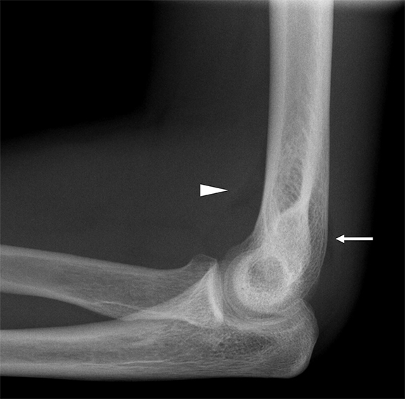 elbow anatomy xray