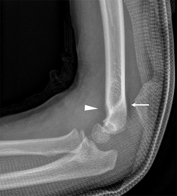 Elbow Effusion: Utility and Limitations of Radiography in Pediatric ...