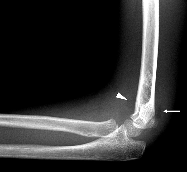 Elbow Effusion: Utility and Limitations of Radiography in Pediatric ...