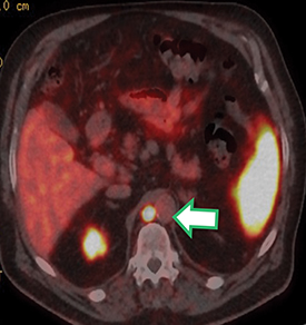 How is a PET scan used in liver cancer?