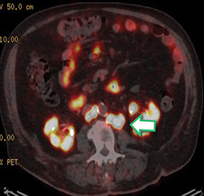 PET Imaging Tool Detects Liver Inflammation due to Fatty Liver