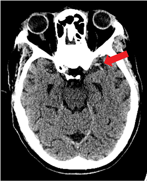 Assessing Brain Tissue Viability on Nonenhanced Computed