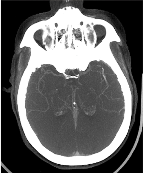 Assessing Brain Tissue Viability on Nonenhanced Computed