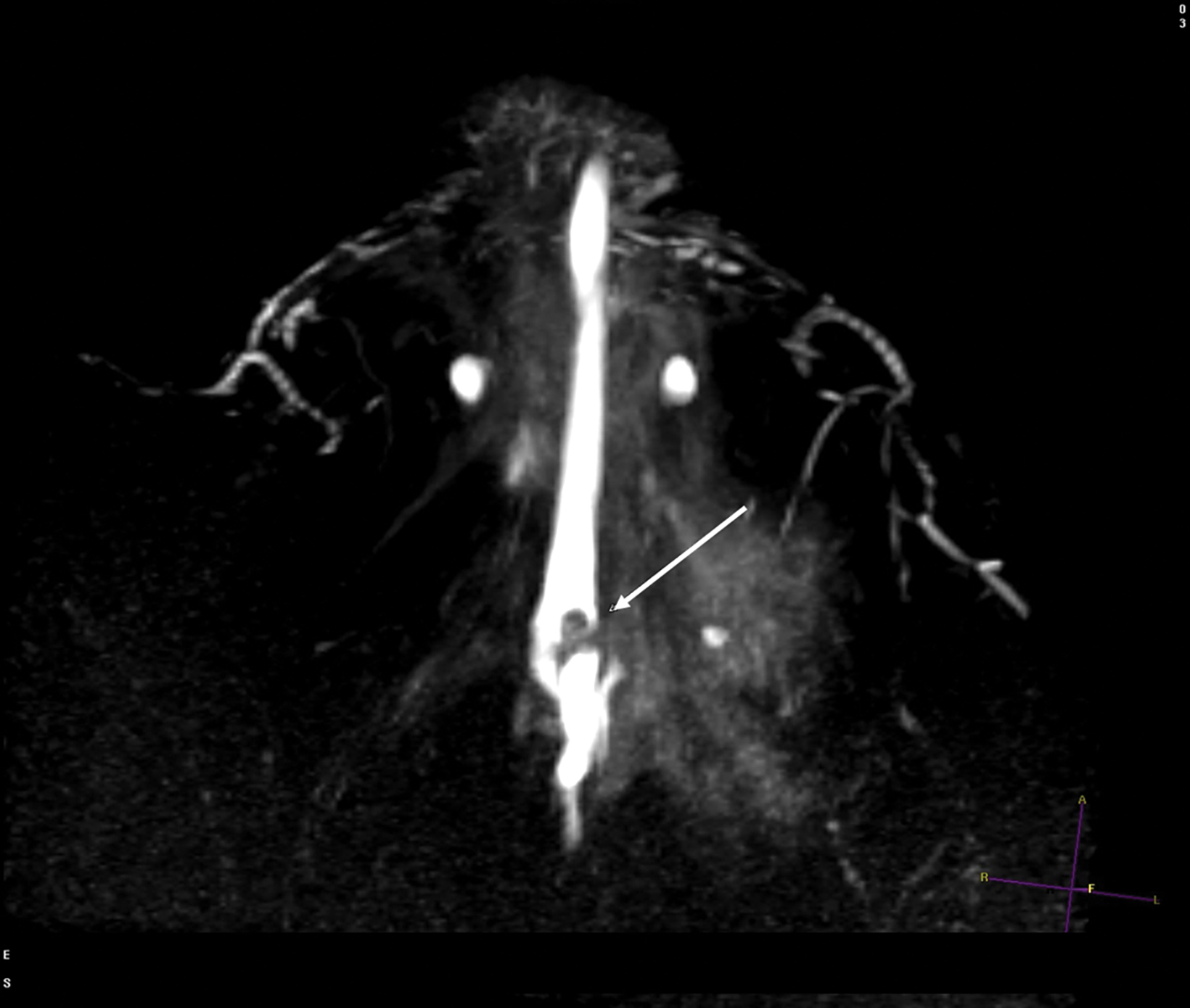 Confirming the new nipple-areolar complex size with a 42-mm