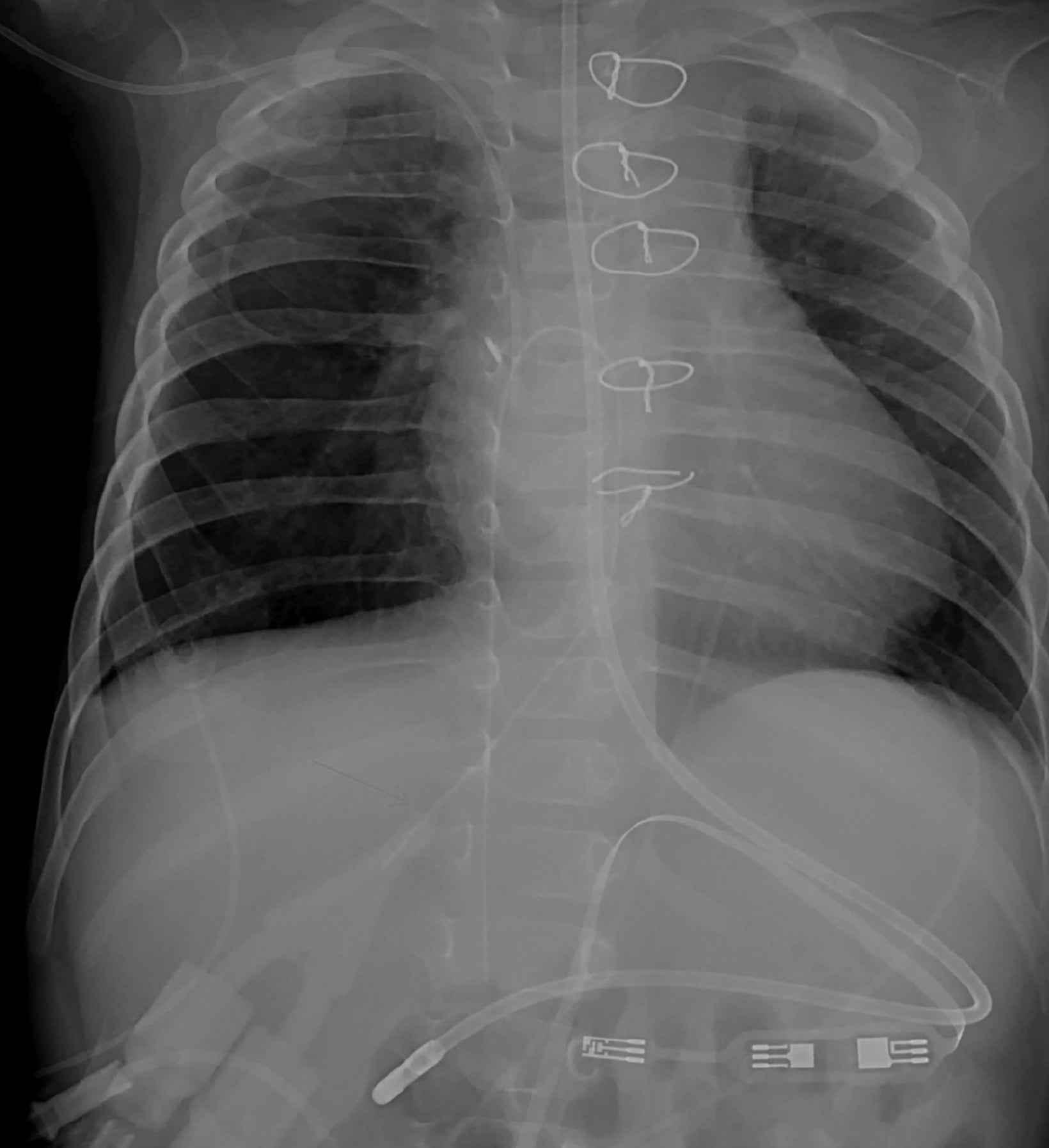 hickman catheter x ray