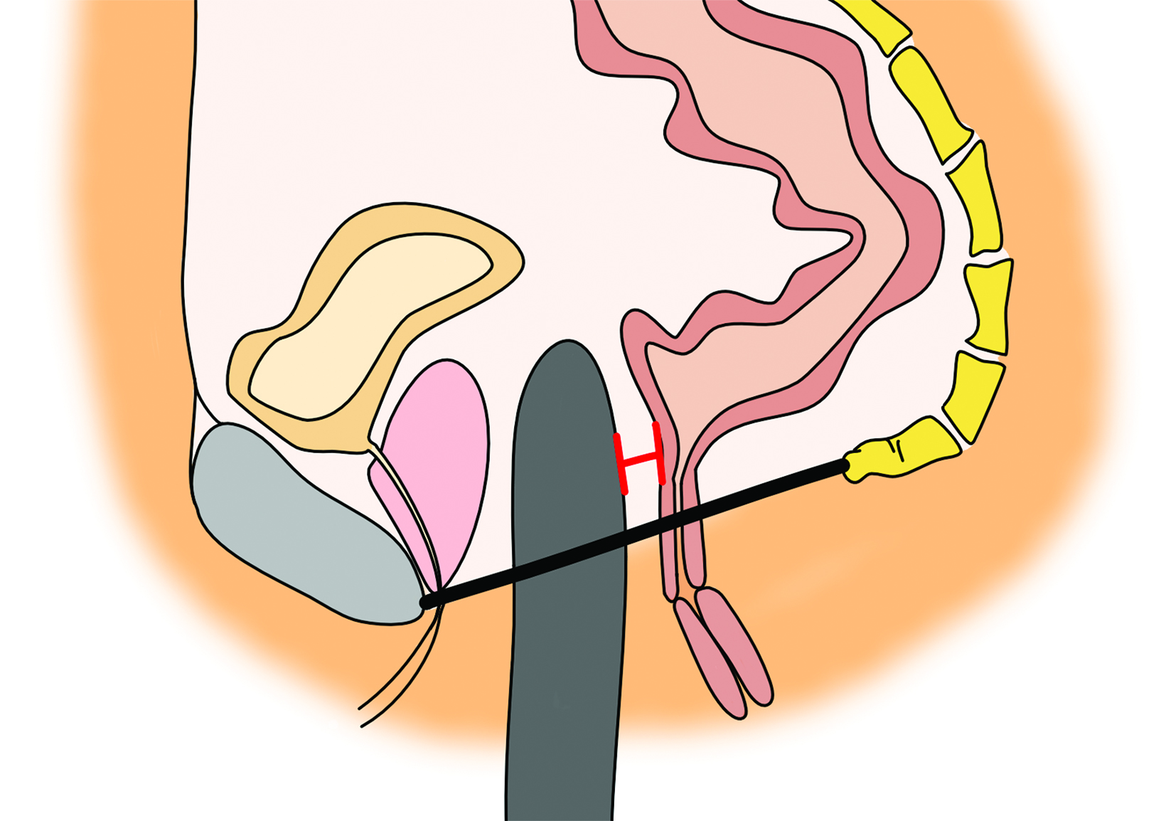 Abdominal and Pelvic Imaging of Transgender Patients • APPLIED RADIOLOGY